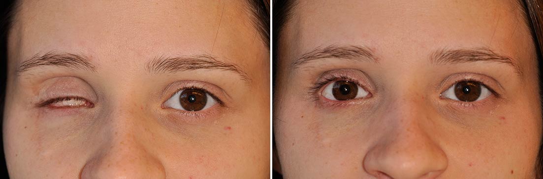 Patient of ocular prosthetics before and after photos.